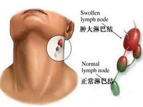 霍奇金淋巴瘤：ABVD方案vs斯坦福V方案