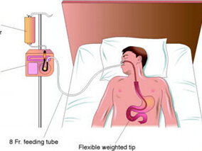 重症患者允许性摄入不足不比标准肠内喂养有优势