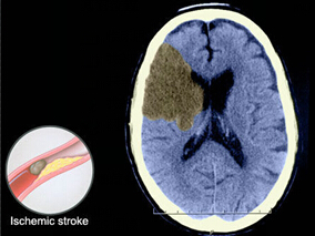 缺血性脑卒中:t-PA联合血栓清除术VS t-PA