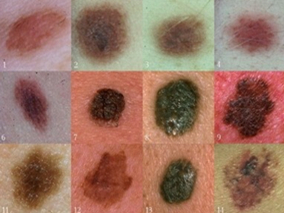 PDE5治疗勃起功能障碍与恶性黑色素瘤风险增加相关