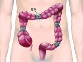 匹维溴铵可减轻肠易激综合症的症状