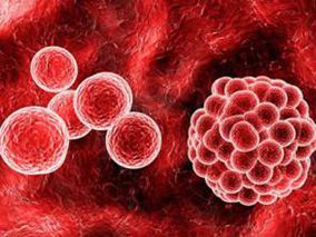 局部放疗+GMSF使转移性实体瘤患者出现异位效应