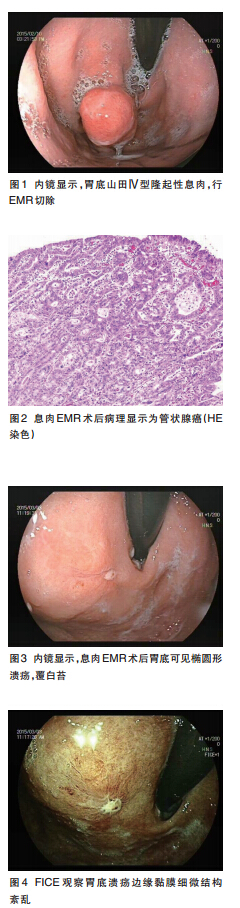 内镜治疗隆起型早期胃癌1例