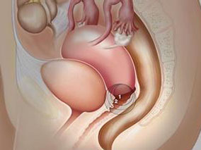 转移或复发性宫颈癌：紫杉醇加卡铂vs紫杉醇加顺铂