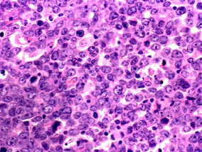 R-CHOP治疗后完全缓解的DLBCL患者仍有较大的复发风险