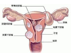 辛伐他汀对子宫肌瘤治疗是否有效？