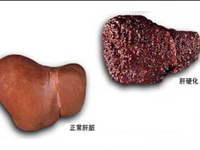 他汀与丙肝患者肝硬化风险降低相关