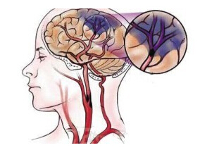 急性缺血性卒中:患者对阿司匹林反应性变化的临床意义