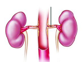 PCI术后的CI-AKI与短期和长期缺血性和出血性事件风险增加独立相关