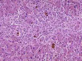 CsA联合SIR治疗未控制移植物抗宿主病患者的效果如何？