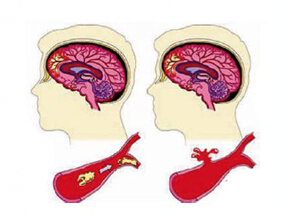 华法林对房颤患者缺血性卒中长期结局的影响