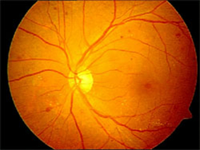 糖尿病黄斑水肿的治疗选择