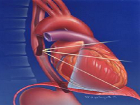 基于碘克沙醇的动态平衡CT或能无创性诊断和定量心脏淀粉样变性