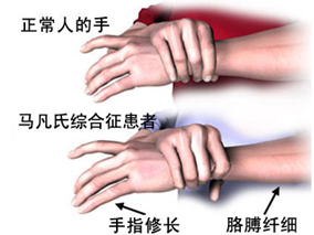 基线治疗添加氯沙坦治疗马凡综合征患者的获益情况