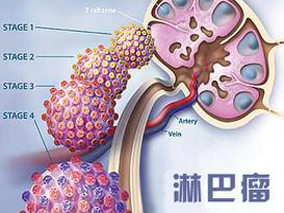 依鲁替尼单药治疗复发/难治MCL疗效持久且安全性良好