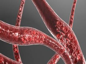 CyBorD对非心血管的AL型淀粉样变性患者有效