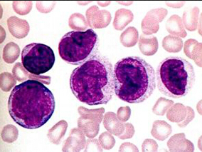伊马替尼一线治疗慢性髓性白血病患者的长期结局