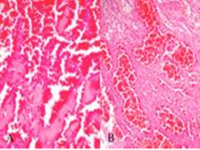 晚期血管肉瘤:紫杉醇是否联合贝伐珠单抗?