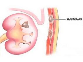 有症状的输尿管结石：坦索罗辛和硝苯地平治疗4周未增加排石率