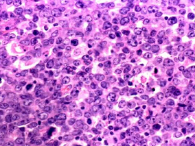 早期弥漫大B细胞淋巴瘤：化学免疫疗法和RIT是积极治疗方案