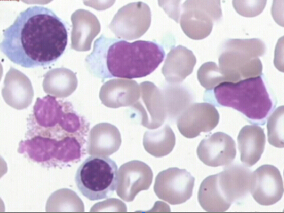 伊鲁替尼+奥法木单抗治疗CLL优于伊鲁替尼单药