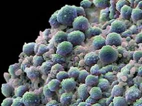 转移性激素敏感性前列腺癌：ADT联合多西他赛治疗效果更佳