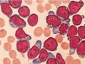 Elotuzumab可显著降低复发或难治性多发性骨髓瘤风险