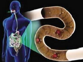 FMT可为有和无IBD儿童患者带来持续的艰难梭菌根除