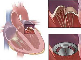 超慢溶栓:人工机械瓣膜血栓形成的治疗新策略和结局预测因子
