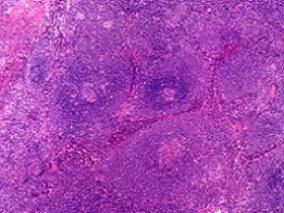 高剂量抗CD20放射免疫治疗可改善自体移植套细胞淋巴瘤患者结局