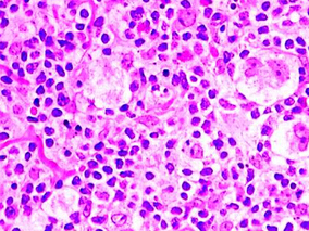 新的化疗方案或能改善复发性难治性霍奇金淋巴瘤患者结局