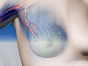 导管内注射对比剂的高分辨率3D MRI或可测量乳腺导管的代谢或靶受体