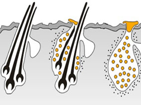 儿童头发皮质醇测量方法的比较