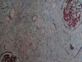 利妥昔单抗治疗复发性嗜酸性肉芽肿血管炎的有效性和安全性