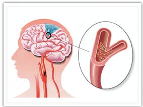维生素D和钙补充剂真能延长缺血性卒中存活者的寿命?