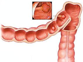 FIT可很好的预测40～49岁患者直肠癌来袭的风险
