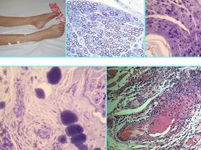 一例ANCA相关小血管炎患者的药学监护