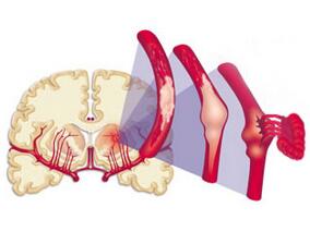 缺血性卒中早期使用他汀可改善结局?