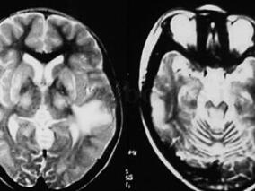 女14岁,奇怪的肝豆状核变性