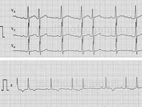 女25岁,间断心悸5年,加重1天,自本次发病以来精神、食欲、睡眠均较差