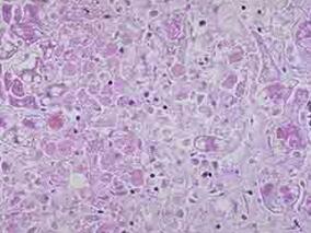 治疗对乙酰氨基酚中毒：乙酰半胱氨酸血药浓度与预期浓度的差异