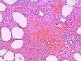 女29岁，以肺和肾损害为首发的结节性脂膜炎1例