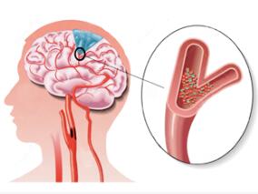 哪些卒中的危险因素最为危险?