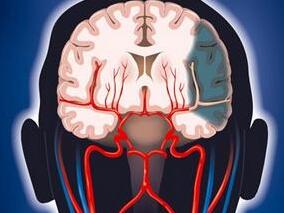 卒中患者:路途偏远的卒中中心与近在咫尺的医院如何抉择?