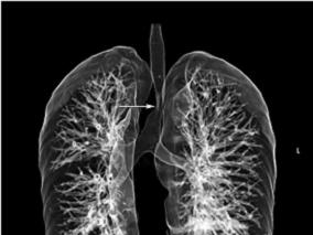 女48岁,反复喘息发作4年,大气道阻塞