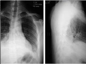 男27岁,反复大咯血26天