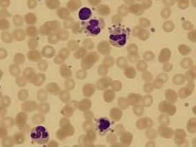 免疫性血小板减少症妊娠女性可能不需要接受治疗