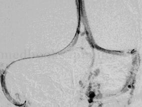 女34岁,头痛伴视物模糊2年半