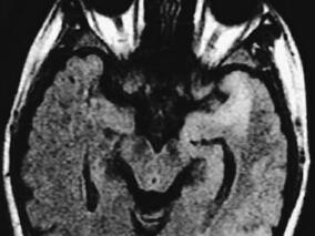 女36岁,因“手机”丢失出现性格改变和精神症状