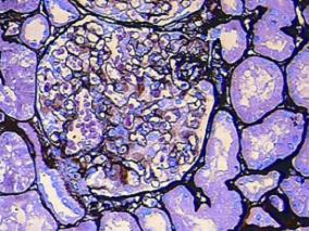 男68岁，颜面部及双下肢水肿1周